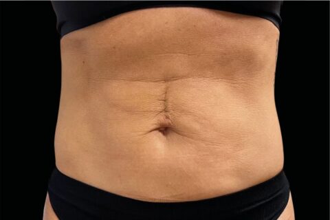 Emsculpt NEO Body Sculpting In Charlotte Shape Med Centers