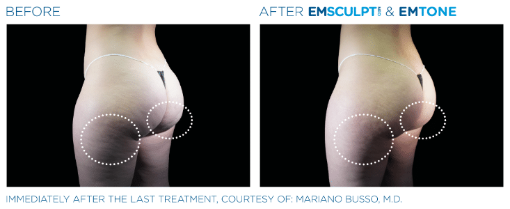 Can Emsculpt Truly Sculpt and Lift the Buttocks?