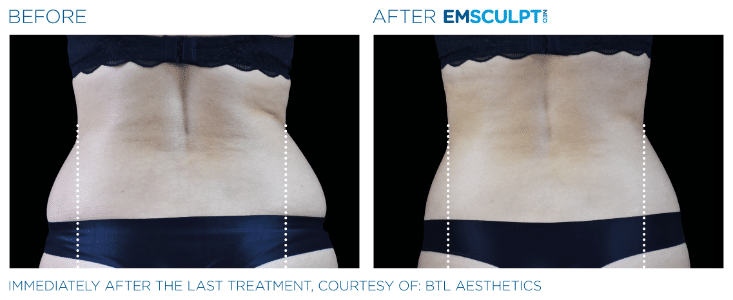 Emsculpt Neo Love handles before and after