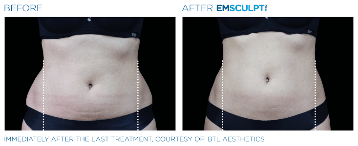 Emsculpt Neo Love handles before and after