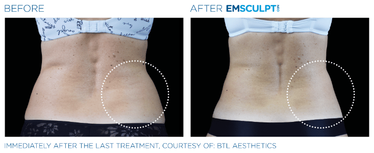 Emsculpt Neo Love handles before and after