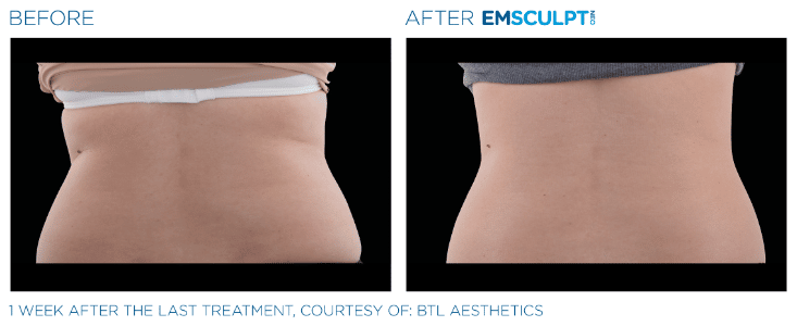 Emsculpt Neo Love handles before and after