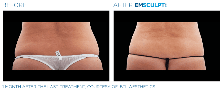 Emsculpt Neo Love handles before and after