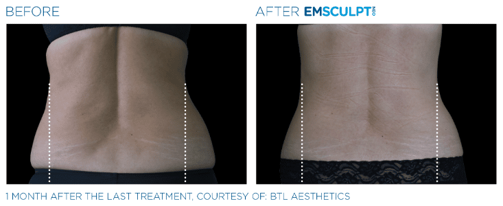 Emsculpt Neo Love handles before and after