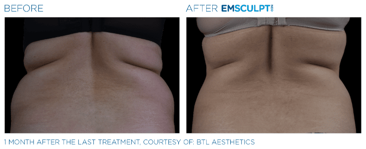 Emsculpt Neo Love handles before and after