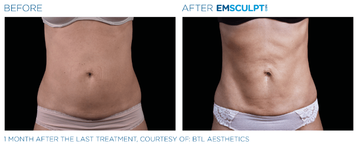 Emsculpt Neo Love handles before and after