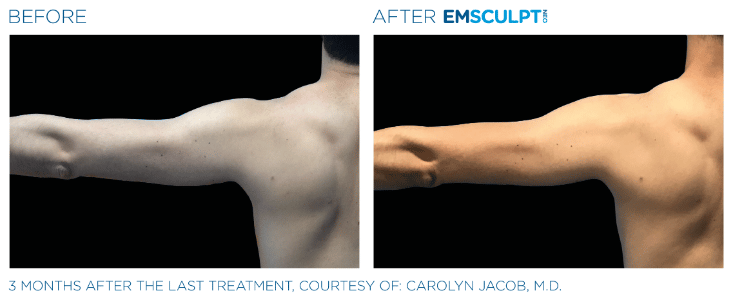 Emsculpt NEO for Arms  Contour + Strengthen Sexy Arms