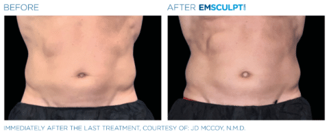 Does Emsculpt Neo Work On Love Handles 