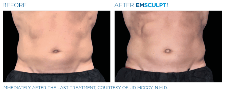 Emsculpt Neo Love handles before and after