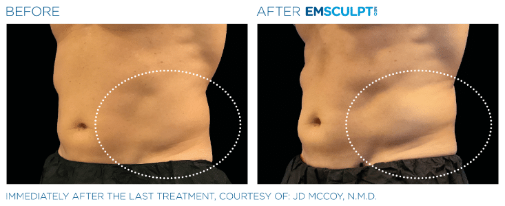 Emsculpt Neo Love handles before and after