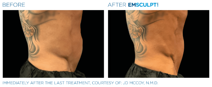 Emsculpt Neo Love handles before and after