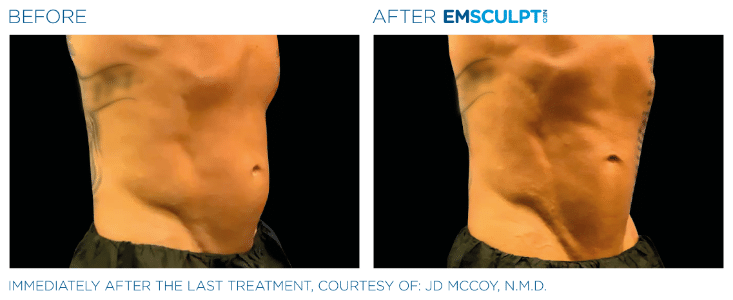Emsculpt Neo Love handles before and after
