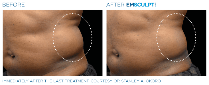 Emsculpt Neo Love handles before and after