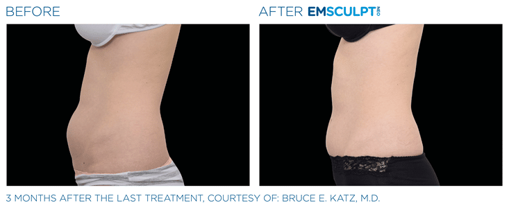 The New Emsculpt NEO  for Muscle and Fat in Middleboro, MA