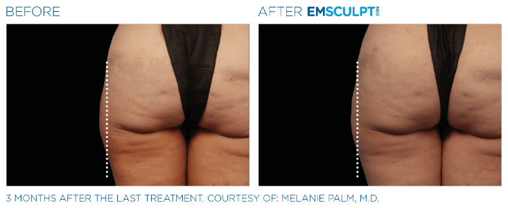 Emsculpt NEO Before and After Thighs