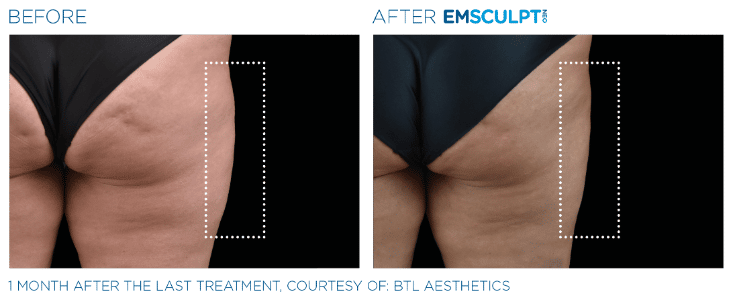 Emsculpt NEO Before and After Thighs