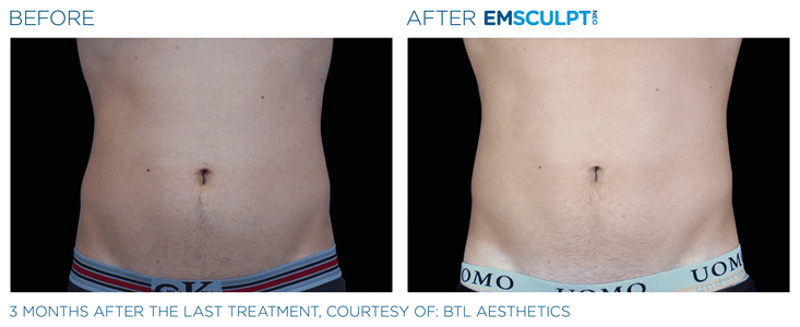 Emsculpt NEO for Abs & Abdomen Before & After