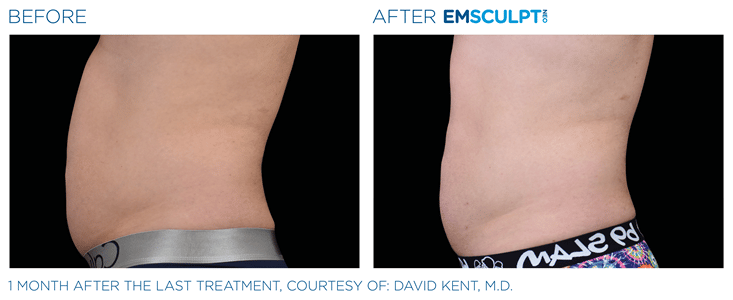 Emsculpt NEO Before and After