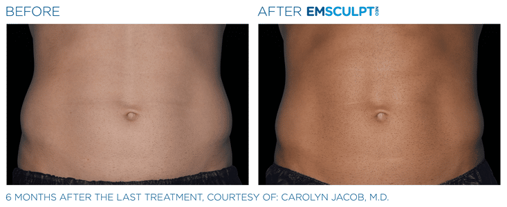 Emsculpt NEO for Abs & Abdomen Before & After