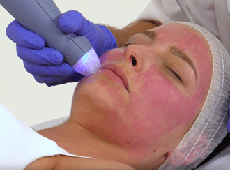 EXION Clear RF: The Future of Skin Rejuvenation is Here 2 EXION Clear RF