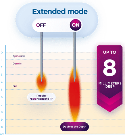 Exion Fractional RF Microneedling