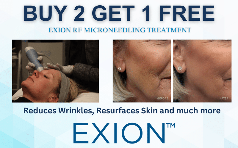 Buy 2 Get 1 Free RF Microneedling at Shape Med Centers