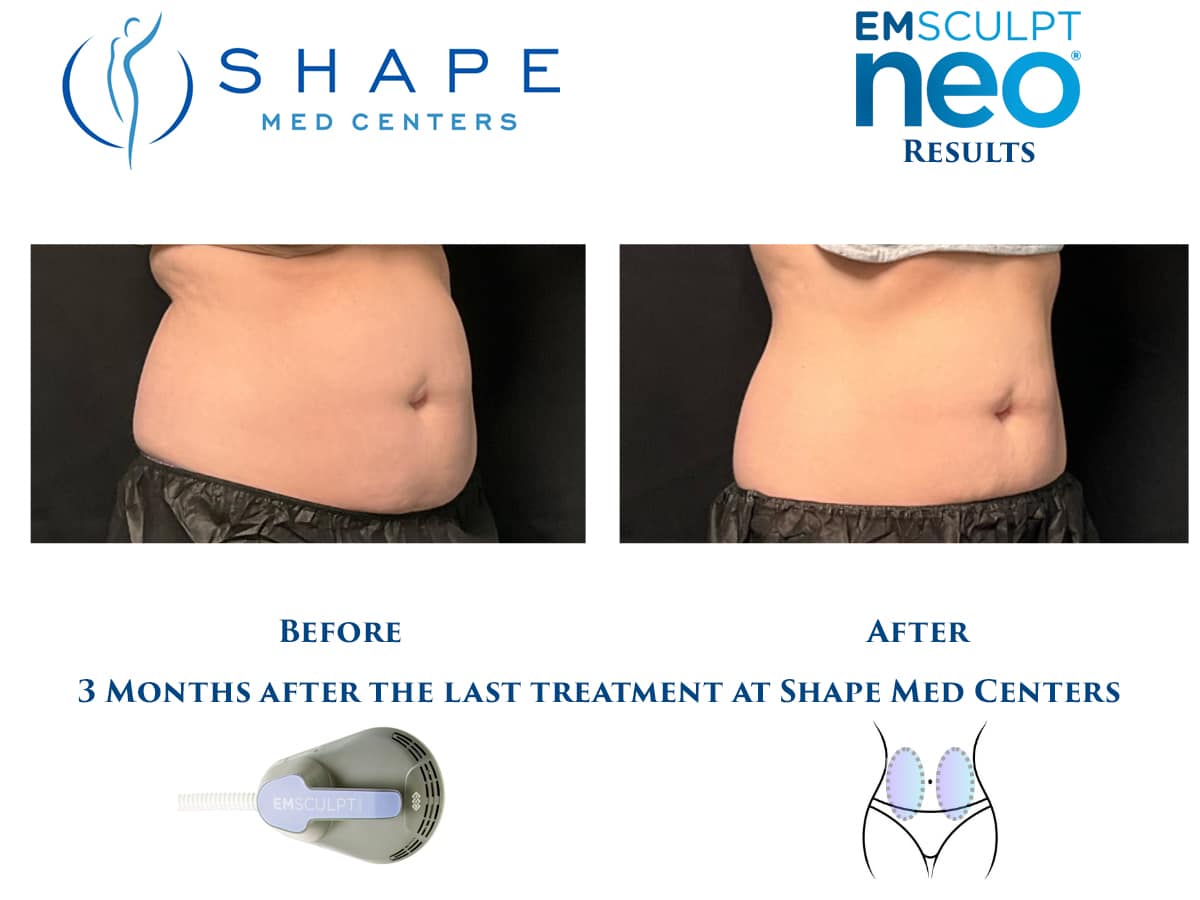 01 Emsculpt NEO before and after abdomen results, oblique view, Shape Med Centers Charlotte