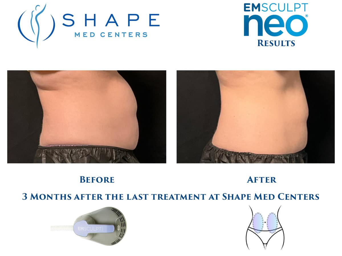 02 Emsculpt NEO before and after abdomen results, side profile, Shape Med Centers Charlotte