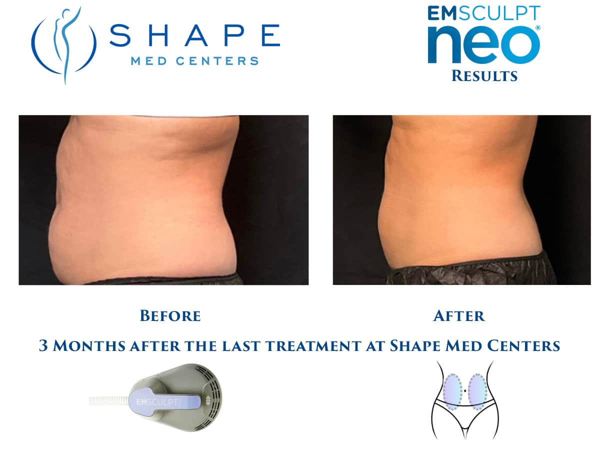 03 Emsculpt NEO before and after waist and flank results, back view, Shape Med Centers Charlotte