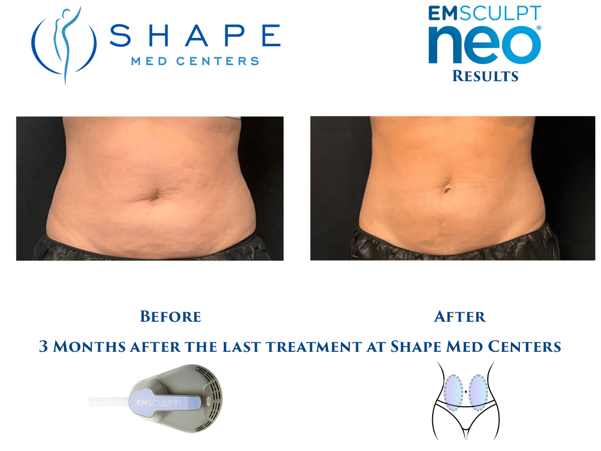 04 Emsculpt NEO before and after abdomen results, front view, Shape Med Centers Charlotte