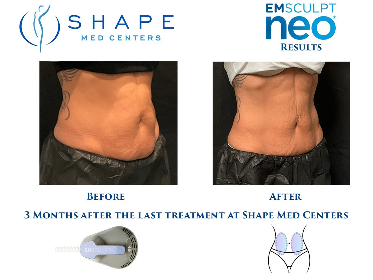 05 Emsculpt NEO before and after stomach profile, Shape Med Centers Ballantyne Charlotte