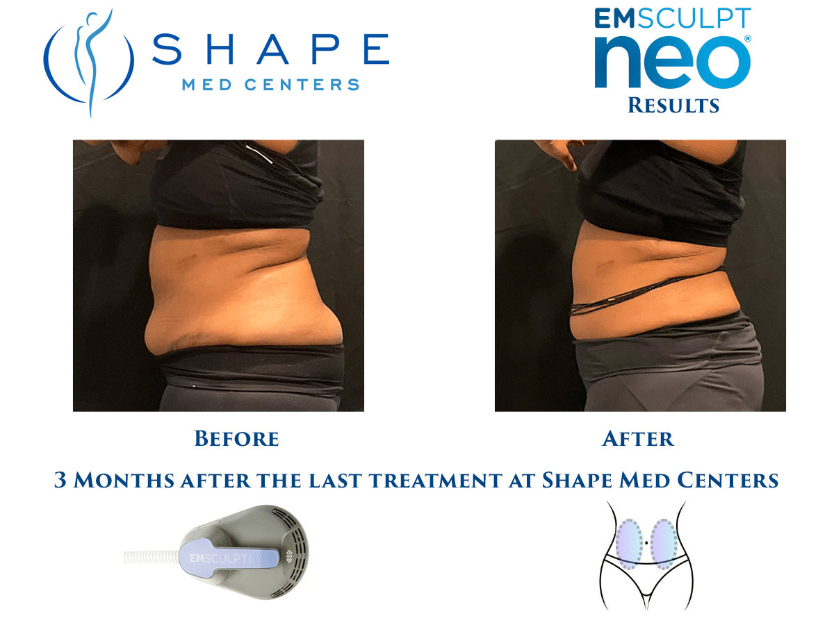 06 Emsculpt NEO before and after abdomen results, side profile, Shape Med Centers Ballantyne