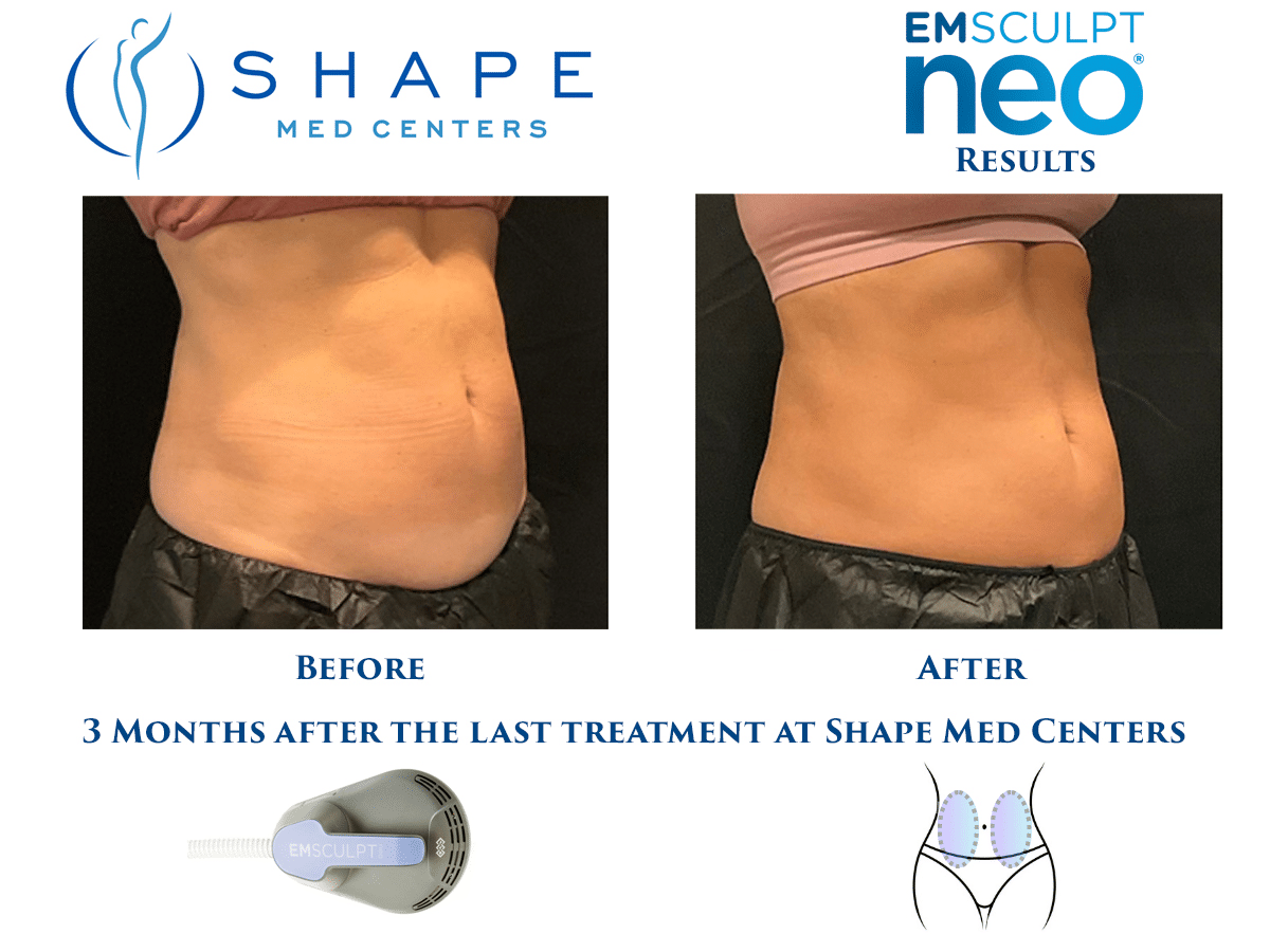 07 Emsculpt NEO before and after stomach results, oblique view, Shape Med Centers Charlotte